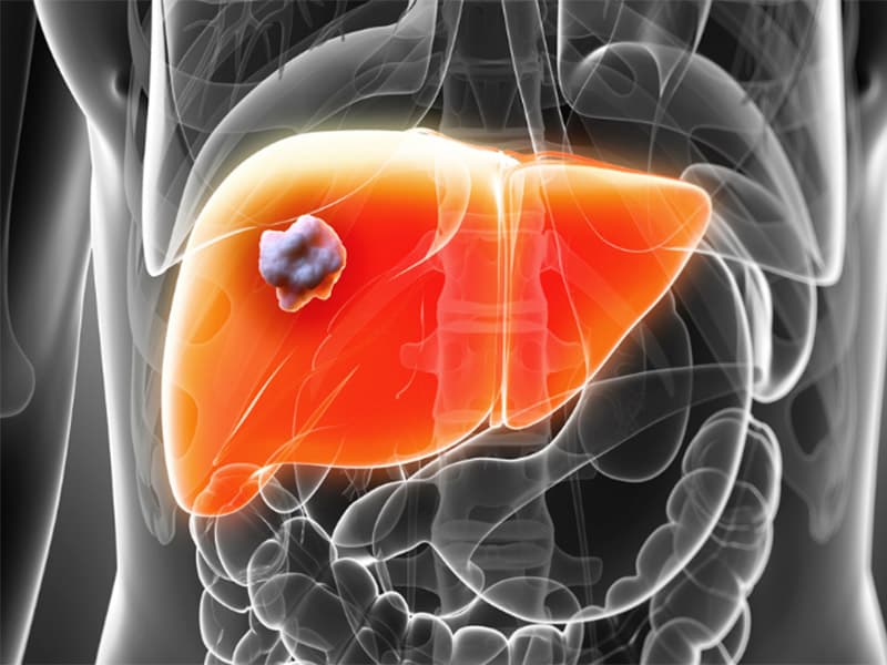 Median à Sophia lève plus de fonds que prévu : 28,1 M€ contre 20 M€ envisagé !