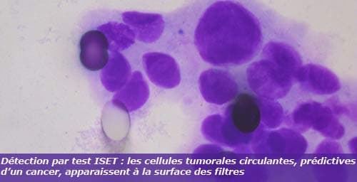 Première mondiale à Nice : le cancer du poumon diagnostiqué des années avant d'être "visible"